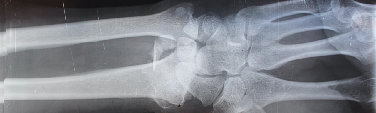Technology is helping take the strain out of treating musculoskeletal injuries in construction Technology is helping take the strain out of treating musculoskeletal injuries in construction